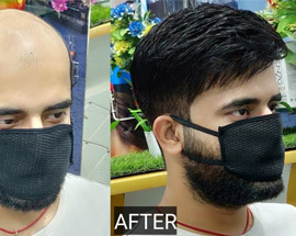 Hair Patch Fixing
